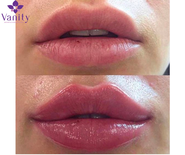 Tạo hình môi với liệu trình filler chỉ có tại Vanity Aesthetics & Beauty Clinic