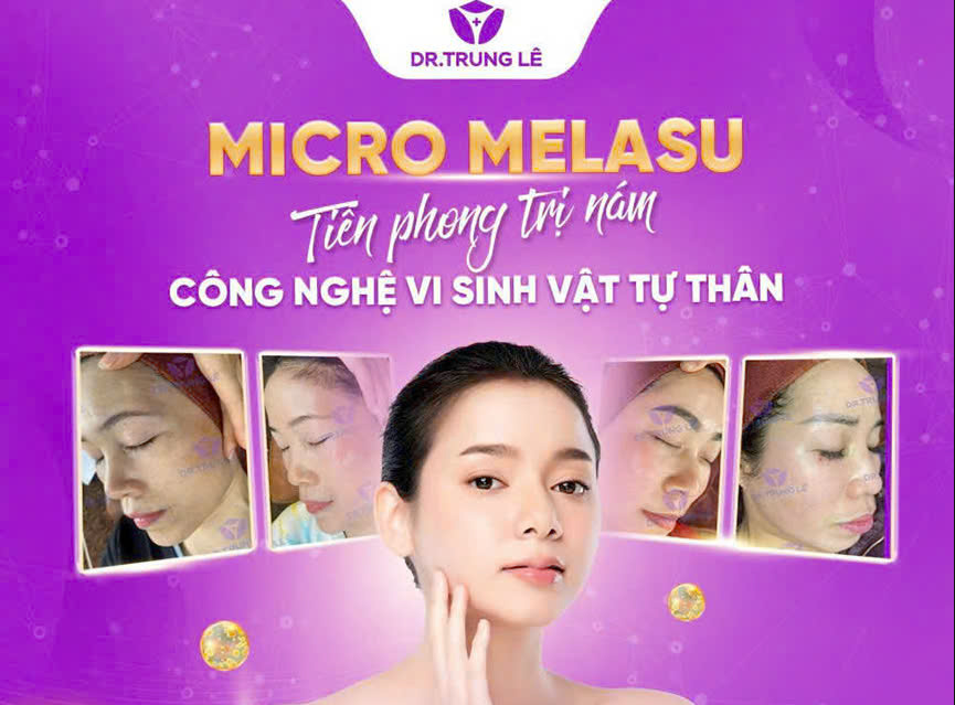 Công Nghệ Trị Nám Đỉnh Cao Micro Melasu – Thành Công Của Ths - Bs Lê Trọng Trung Tại DR TRUNG LÊ